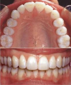 Orthodontics after