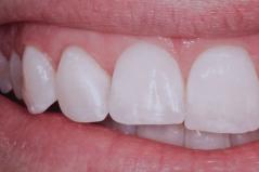 Cosmetic Dental Gum Surgery After