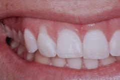 Cosmetic Dental Gum Surgery Before