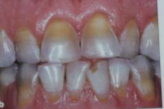 Cosmetic Dental Veneers Before