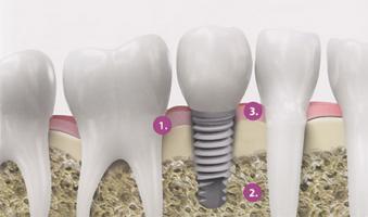 Implant resized5