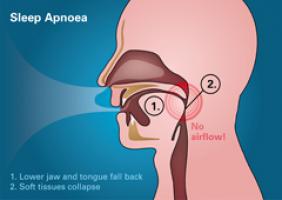 Somnowell Sleep Apnoea Graphic 240