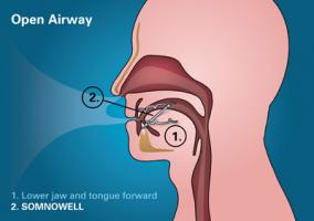 Somnowell Open Airway Graphic 800