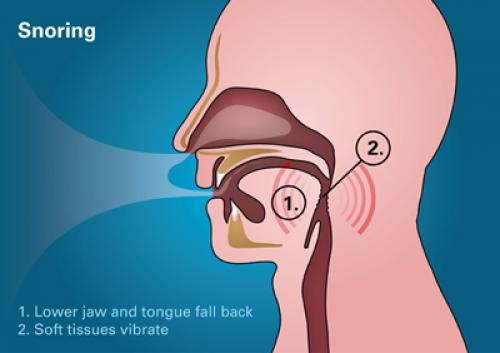 Somnowell Snoring Graphic 800